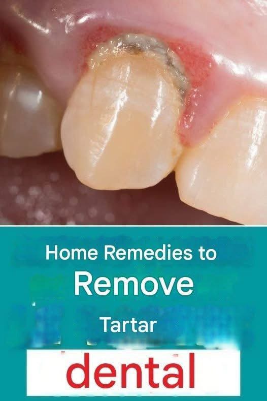 The Hidden Danger of Tartar: What Your Dentist Wants You to Know