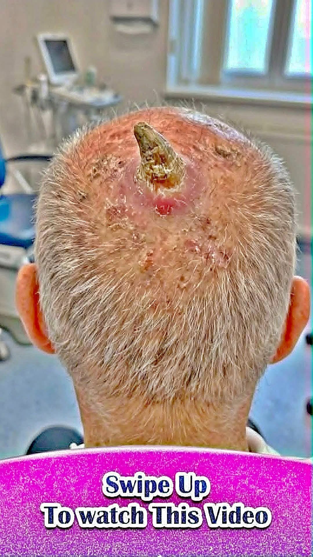 The Hidden Struggle with Severe Acne: What You Need to Know