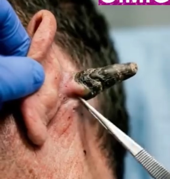 The Startling Truth Hidden Inside Giant Blackheads
